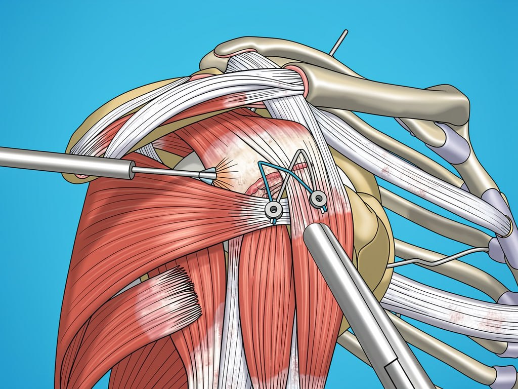 Hip Revision Surgery