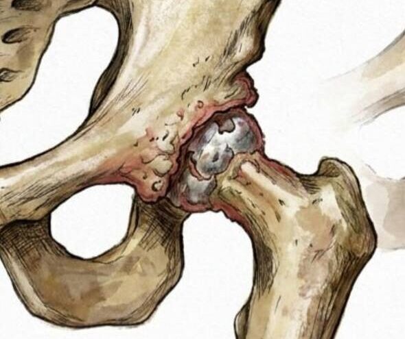 Hip Revision Surgery